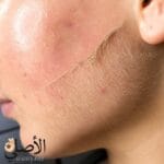 الآثار الجانبية المحتملة للديرمابلانينج